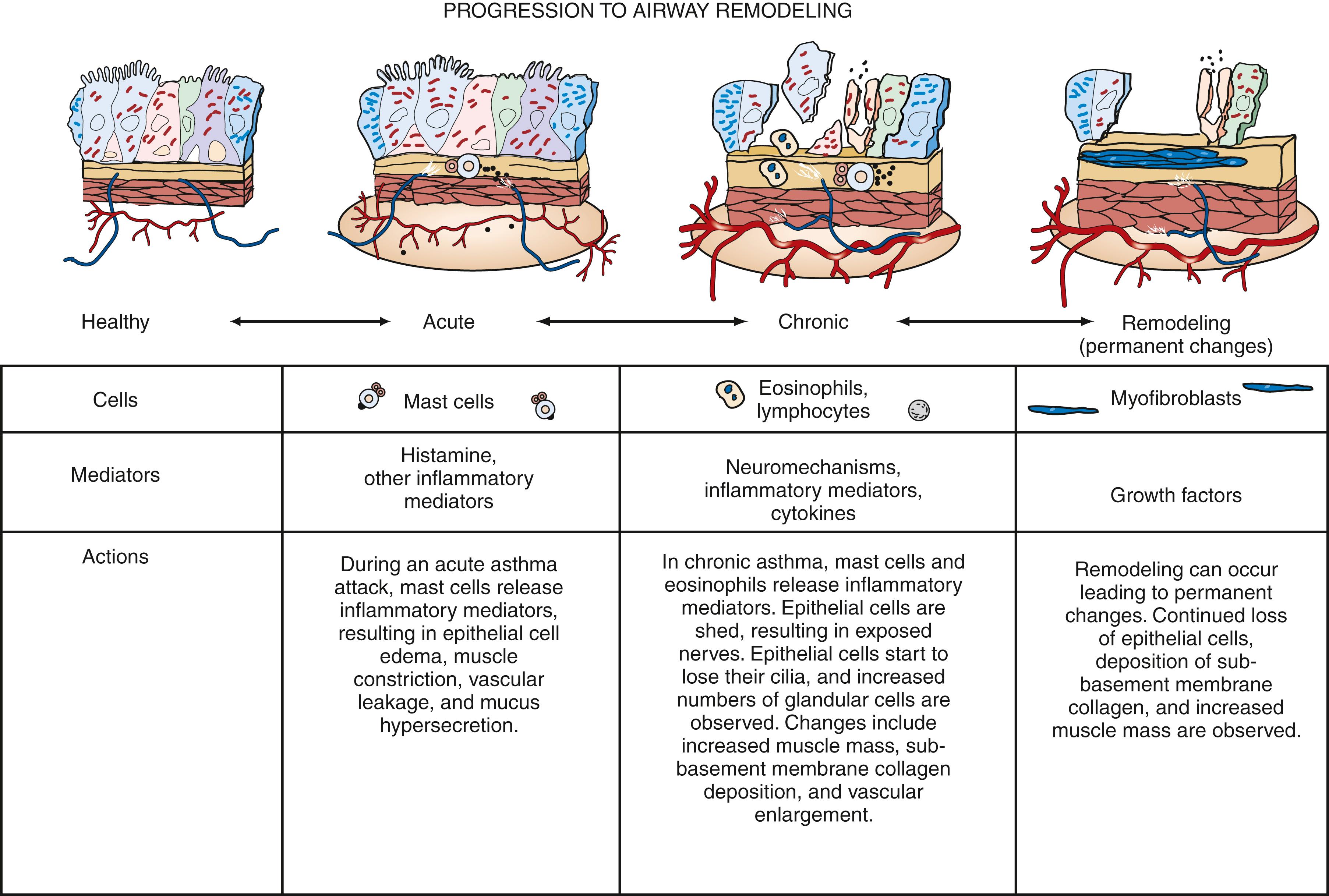 Fig. 4.23, Asthmatic inflammation may result in permanent changes in the airways. This process is known as remodeling.