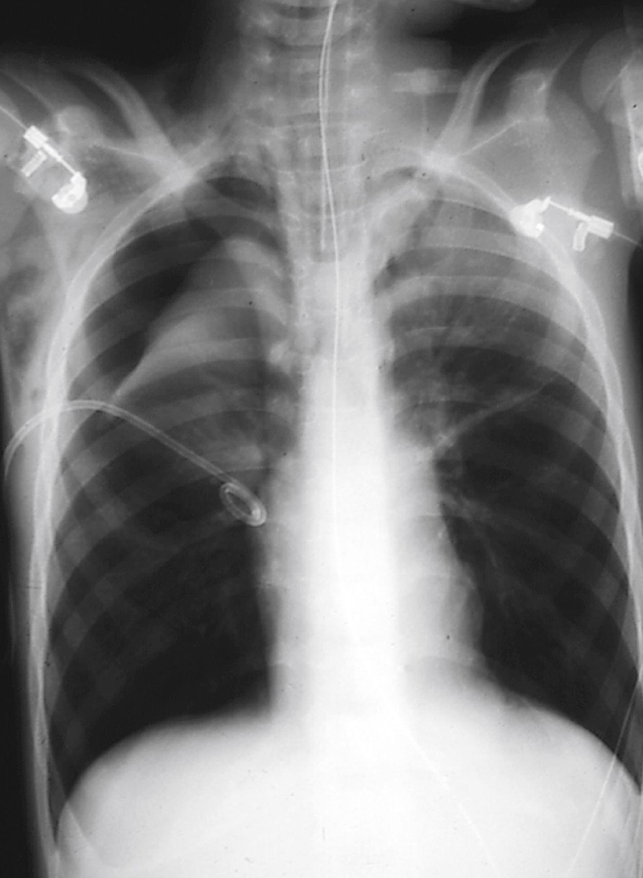 Fig. 4.25, Chest radiograph showing right-sided pneumothorax in an intubated patient with acute asthma and respiratory failure. Clinical manifestations include pleuritic chest pain, dyspnea, cyanosis, tachypnea, and cough. Also, note the marked hyperinflation of the lungs, which can result in cardiac compression (narrow cardiac shadow) and compromise of cardiac venous return, as well as extensive right-sided subcutaneous emphysema.