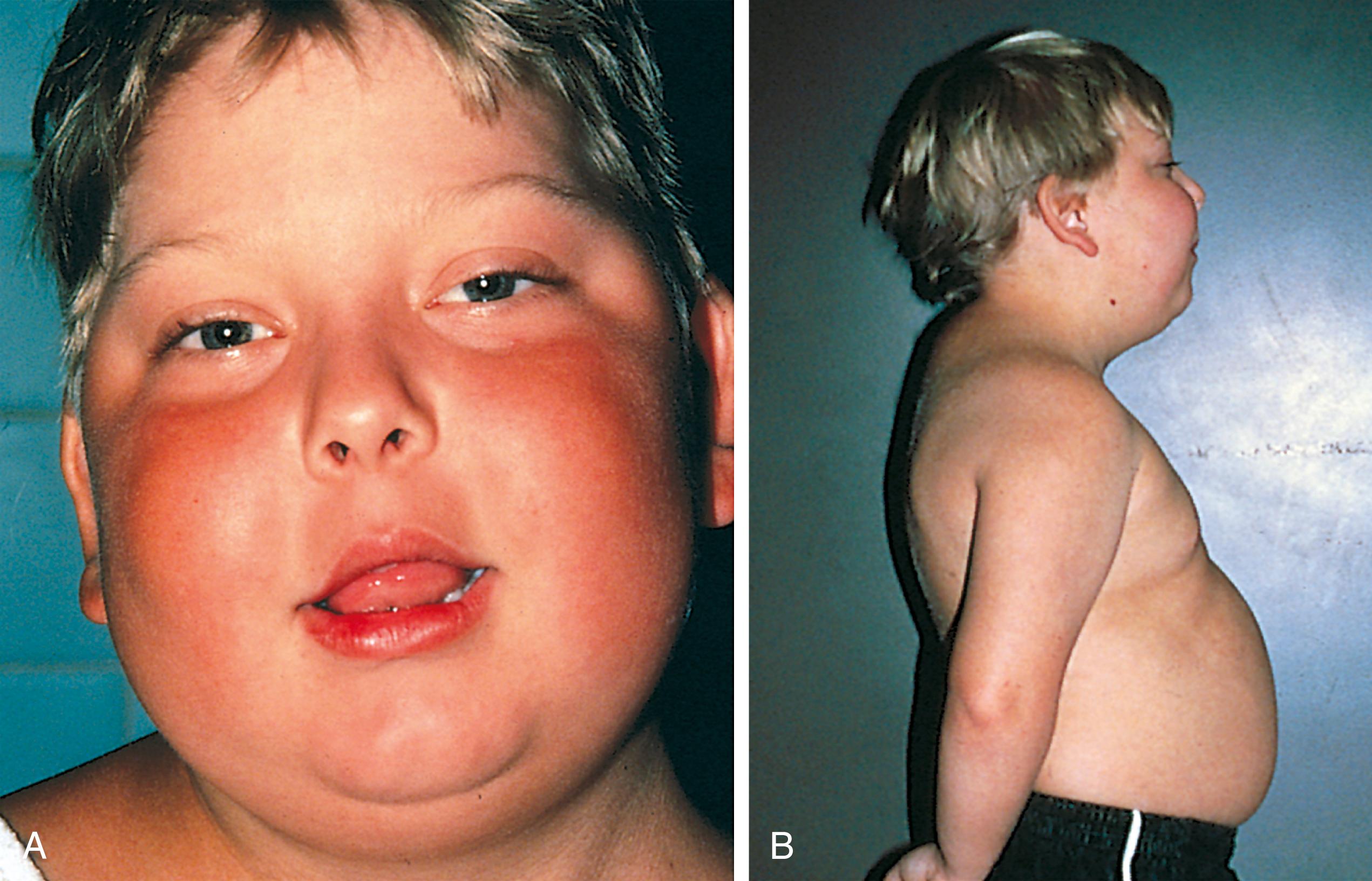 Fig. 4.27, Steroid-dependent asthma. Shown are complications of corticosteroid therapy for chronic asthma: moon-type facies (A) and buffalo hump (B), both resulting from abnormal fat distribution.