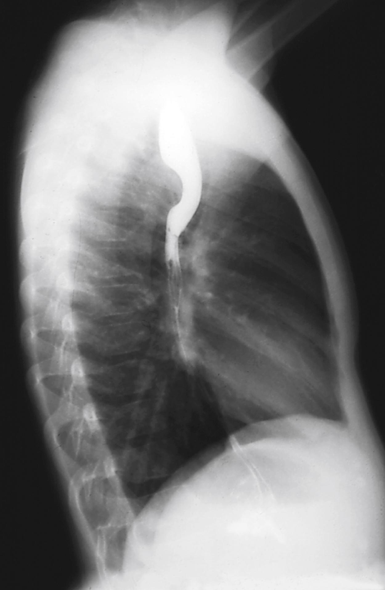 Fig. 4.29, Vascular ring/compression. Barium swallow (lateral chest radiograph) shows upper airway compression by a right-sided aortic arch with aberrant left subclavian and diverticulum at the left subclavian origin. Note the round indentation on the posterior wall of the esophagus and the anterior displacement and compression of the trachea, which can cause wheezing and mimic asthma.