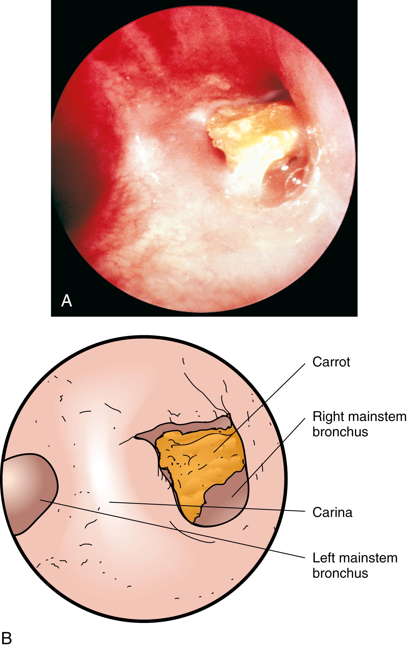 Fig. 4.30, Airway foreign body. (A) A piece of carrot is lodged in the right-stem bronchus just below the carina, as visualized during bronchoscopy. (B) Artist rendition of carrot location in bronchi. Foreign bodies such as this can cause airway obstruction that is partially responsive to bronchodilator therapy.