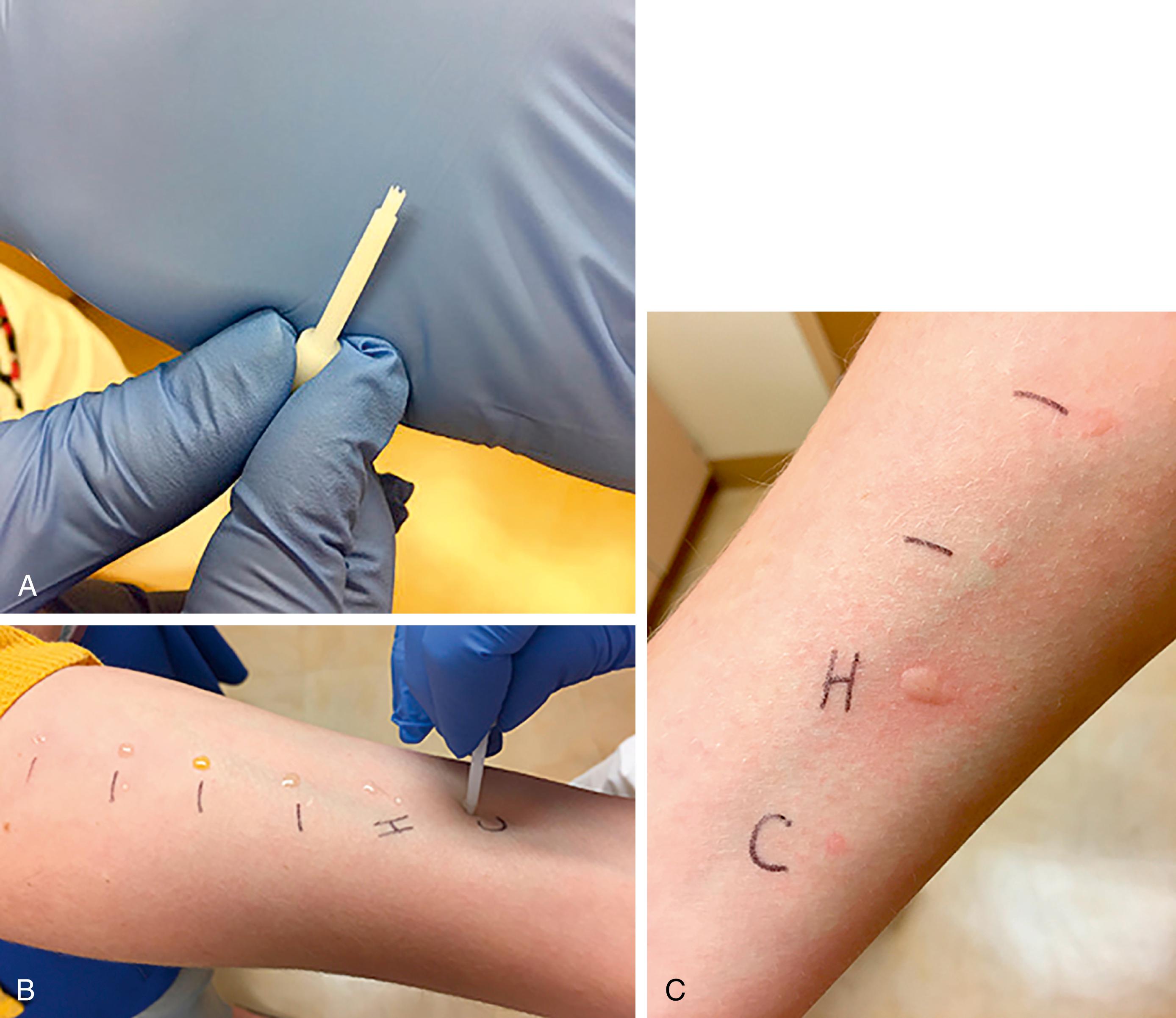 Fig. 4.3, Allergy prick tests. (A) The skin prick test is typically performed with a plastic lancet on either the forearm or upper back. (B) The test leaves a barely visible mark and should be nearly painless. (C) The test is interpreted after 15 minutes by measuring the maximal diameter of both the wheal and the flare.