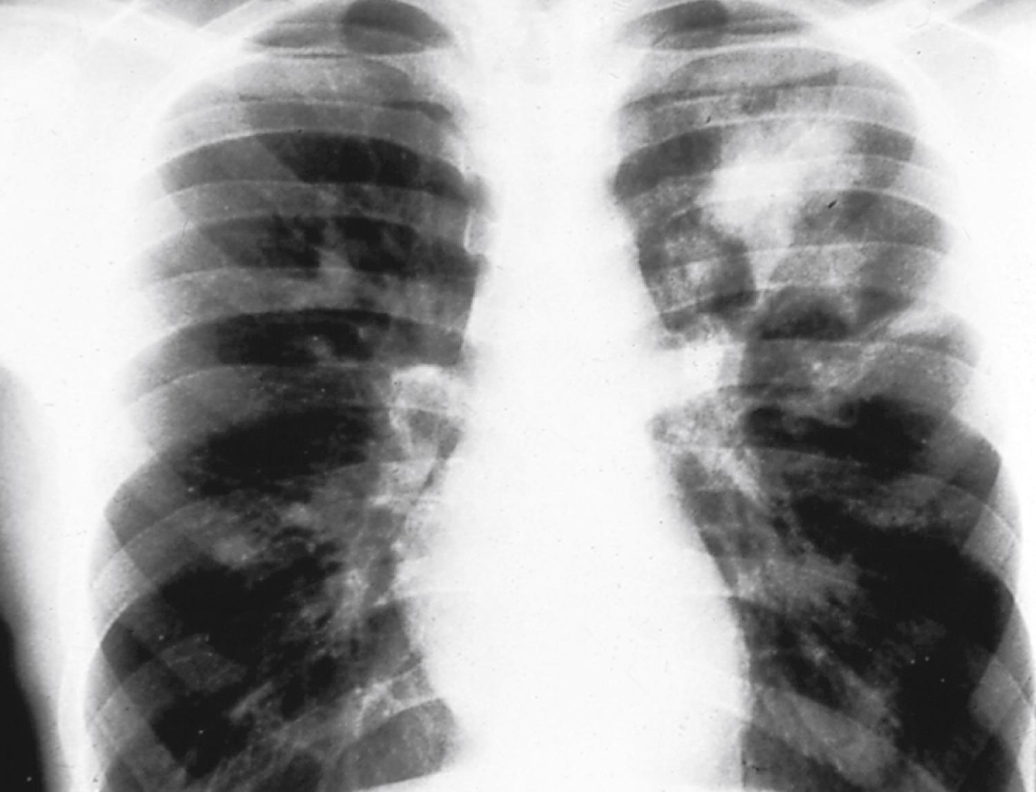 Fig. 4.31, Chest radiograph of patient with allergic bronchopulmonary aspergillosis (ABPA). These patients are frequently asymptomatic despite extensive areas of consolidation.