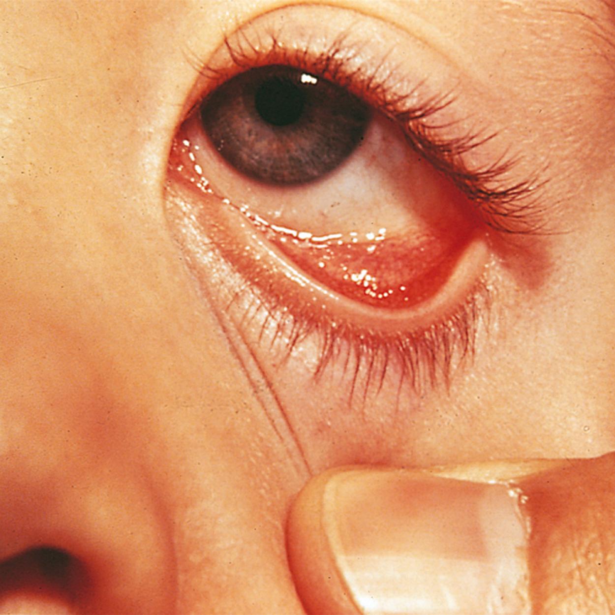 Fig. 4.33, Allergic cobblestoning of the conjunctiva in chronic allergic conjunctivitis. This granular appearance is due to edema and hyperplasia of the papillae.