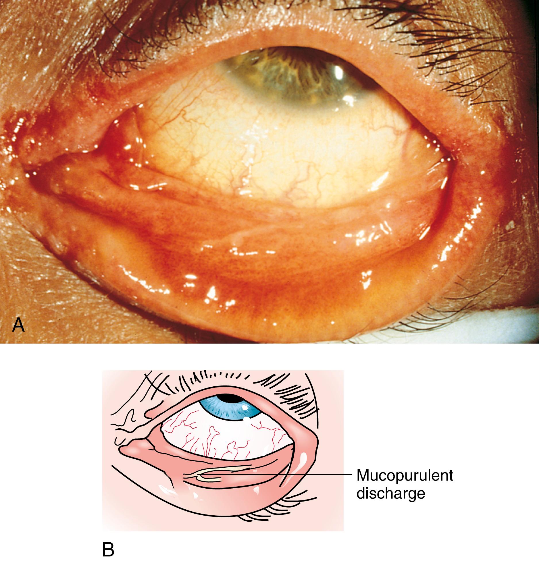 Fig. 4.34, (A) Atopic keratoconjunctivitis with chronic papillary conjunctivitis. (B) Note the stringy mucopurulent discharge often seen in this disorder.