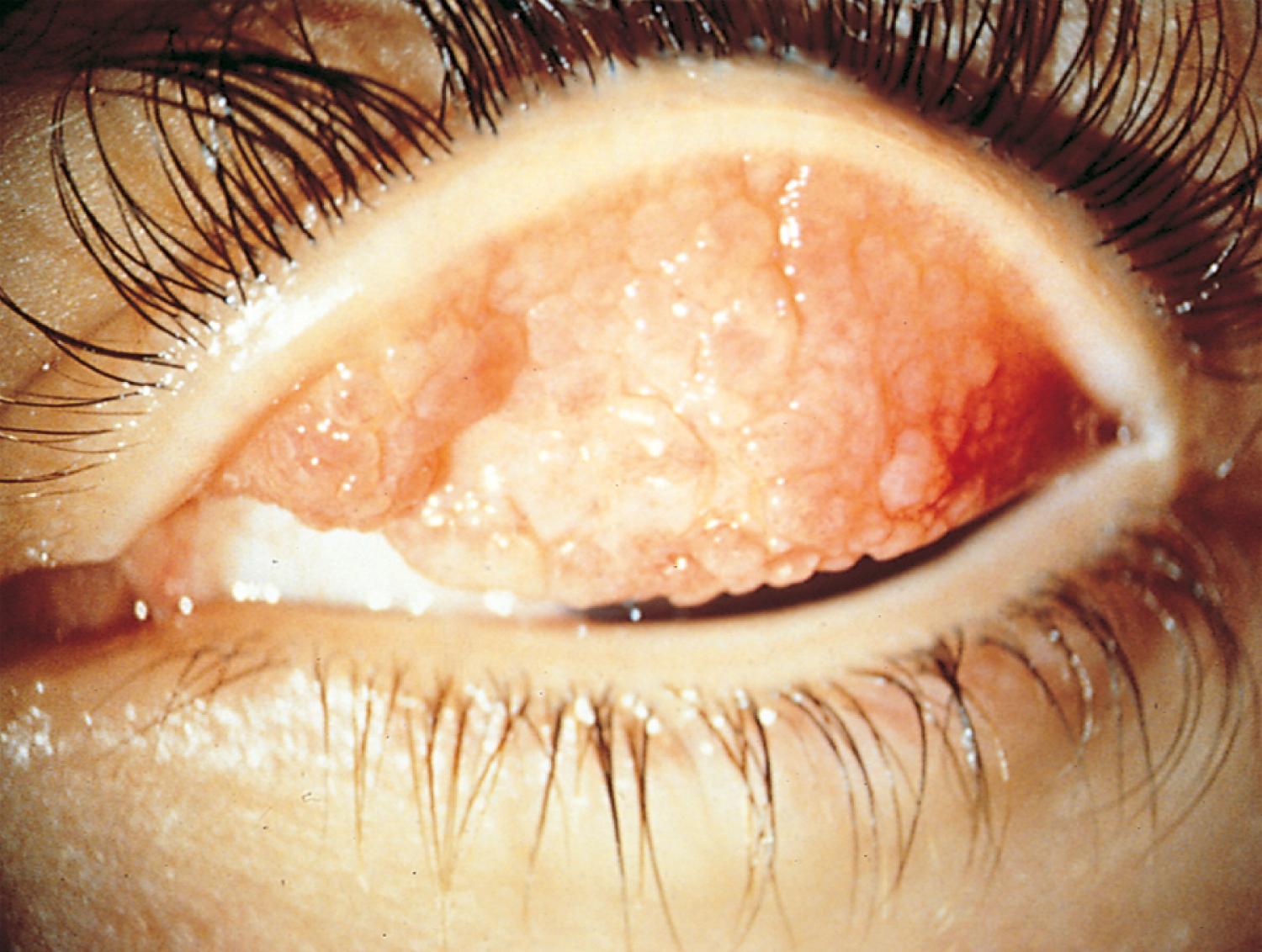 Fig. 4.35, Vernal conjunctivitis, palpebral form. The giant papillary elevations are easily seen without magnification.