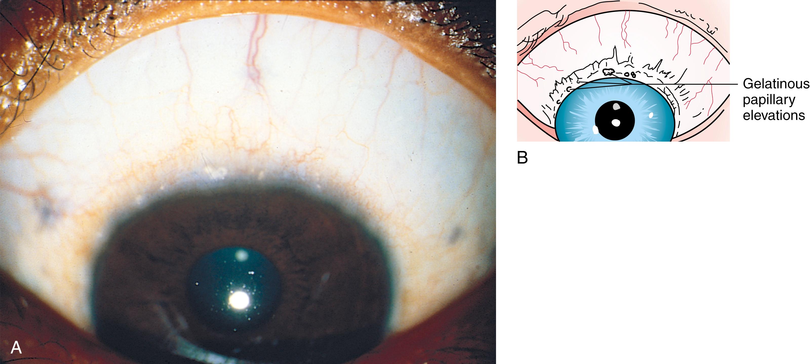 Fig. 4.36, (A) Vernal conjunctivitis, limbal form. (B) Note the gelatinous papillary elevations of the limbal tissue.