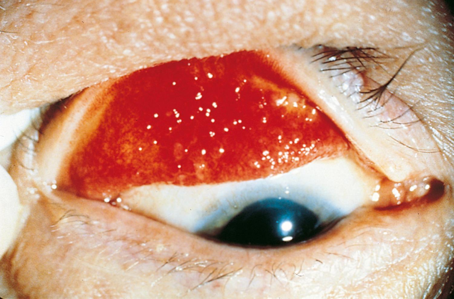 Fig. 4.37, Giant papillary conjunctivitis. These hobnail-like elevations of the upper tarsal conjunctiva, evident on eversion of the upper eyelid, occur when the upper lid meets a foreign body, such as a contact lens, prosthesis, or exposed suture.