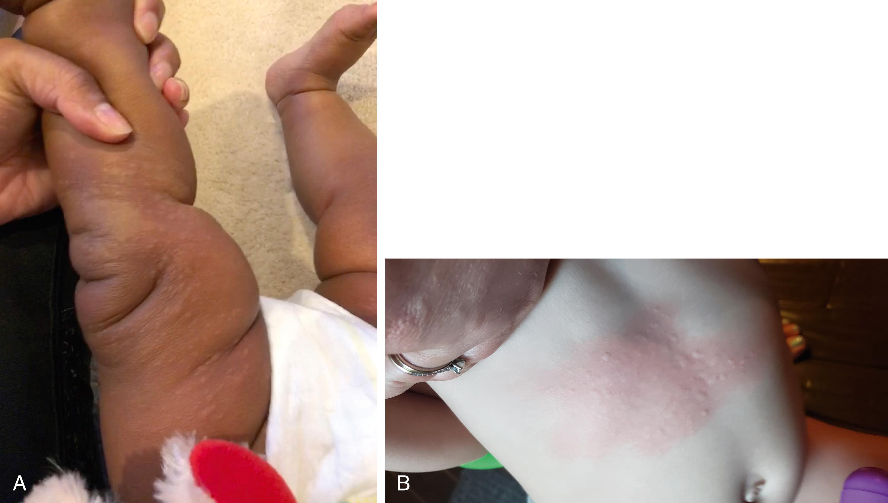 Fig. 4.38, (A) Urticarial lesions on darker pigmented skin and (B) lighter pigmented skin. Note the well-demarcated borders, redness, elevation, and occasional confluence of the palpable lesions.