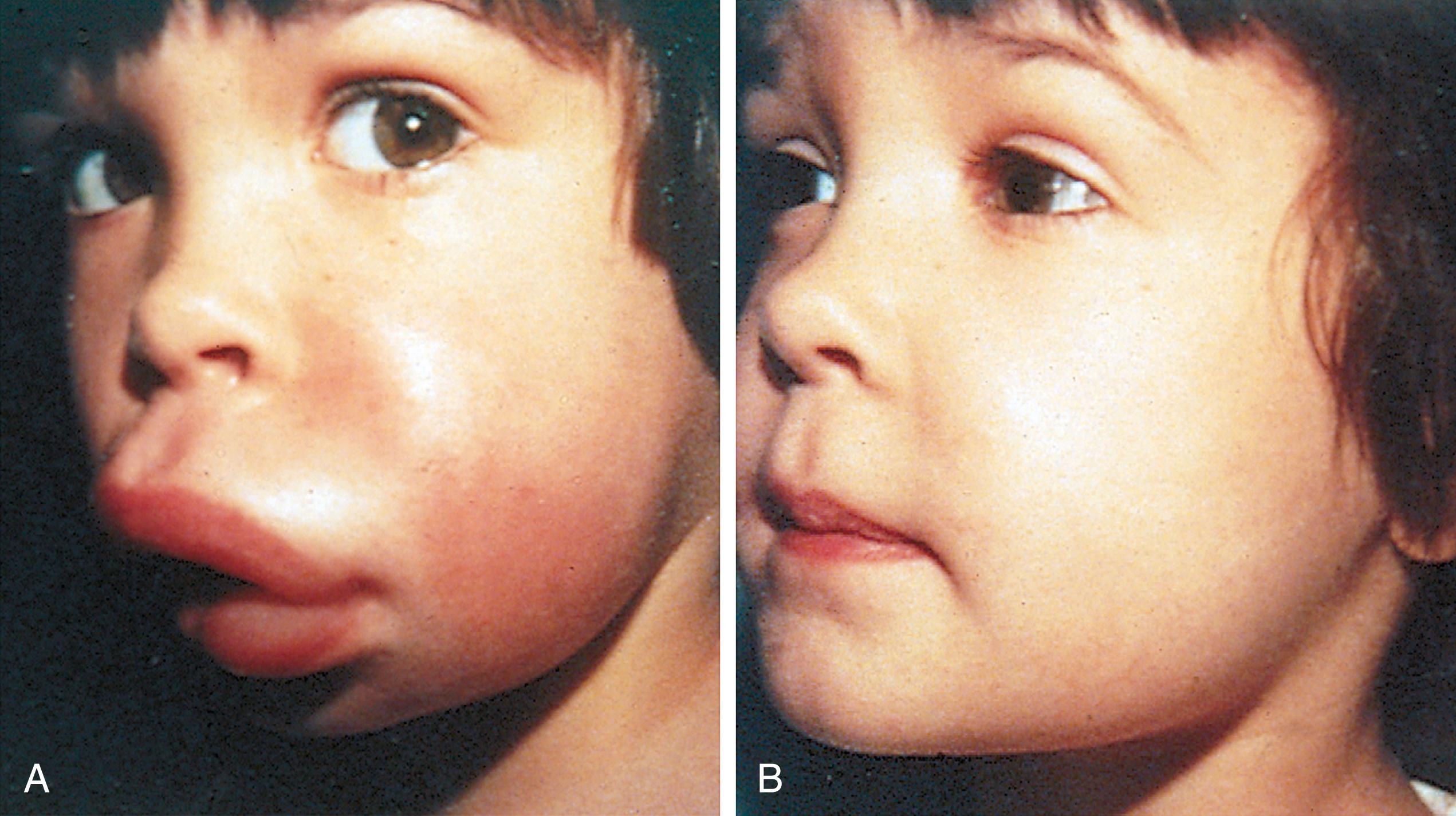 Fig. 4.39, Angioedema. (A) Onset was sudden. (B) Resolution was complete within 24 hours.