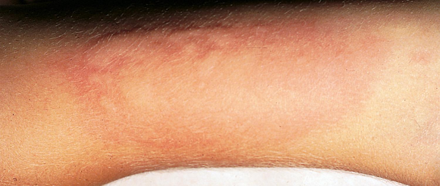 Fig. 4.40, Positive ice cube test in a child with cold urticaria. An ice cube placed on the arm for 10 minutes results in urticaria of the exposed skin. Onset is usually immediate but may be delayed for up to 4 hours after cold exposure.