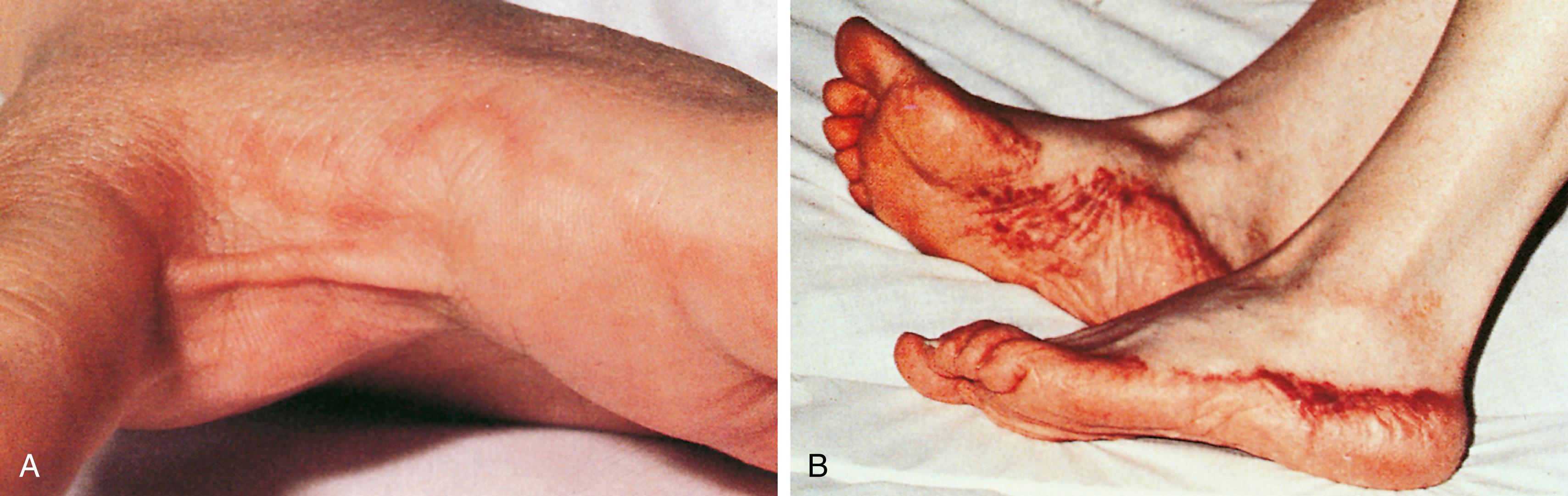 Fig. 4.9, Cutaneous eruptions on the sides of the hands and feet of patients with serum sickness. (A) A scalloped band of erythema can be seen on the side of the finger at the margin of the palmar skin. (B) A band of purpura is seen at the margin of the plantar skin. The purpura was preceded by a band of erythema.