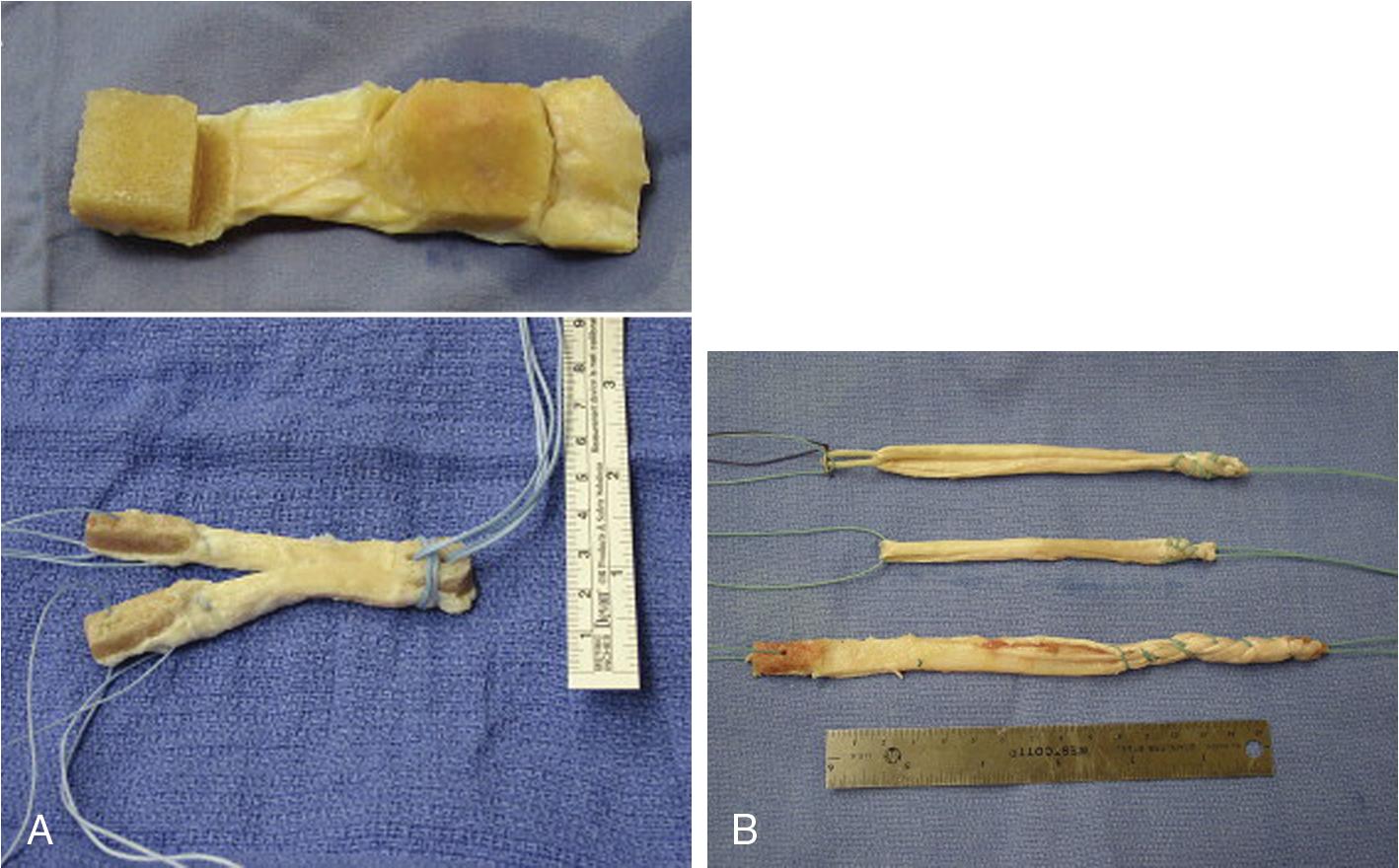 Fig. 83.1, Assorted graft options. (A) Bone–patellar tendon–bone allograft. Note the dual bone blocks, which improve incorporation time and fixation strength. (B) Assorted allograft tissues: semitendinosus tendon (top), gracilis (middle) , and Achilles tendon (bottom).