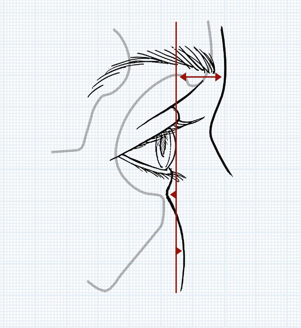 Fig. 24.1, Sagittal relations of the anterior surface of the cornea to the soft tissues overlying the supraorbital and infraorbital rims. On average, in the young adult, the supraorbital rim projects 10 mm beyond, the infraorbital rim lies 3 mm behind, and the cheek prominence projects 2 mm beyond the anterior surface of the cornea.