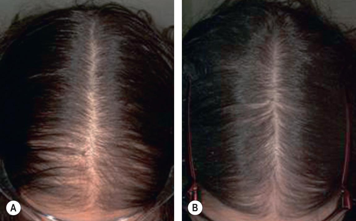 Fig. 69.11, Female pattern hair loss in a 10-year-old girl.