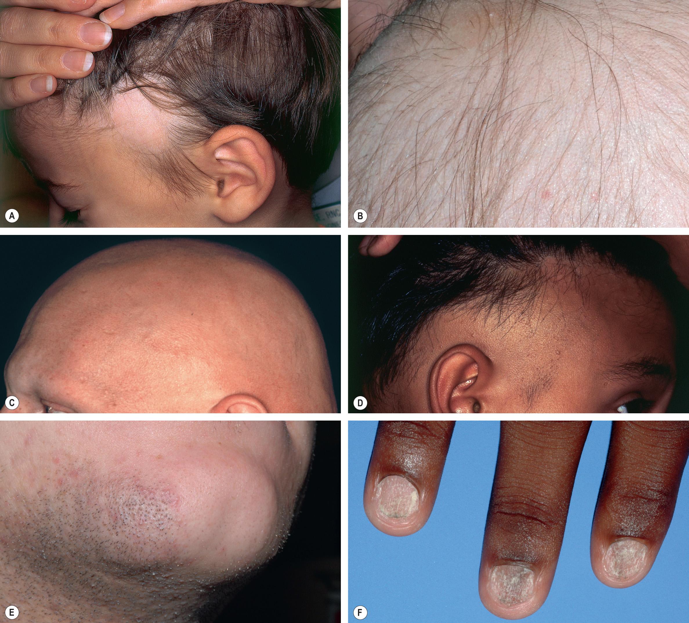 Fig. 69.14, Alopecia areata.