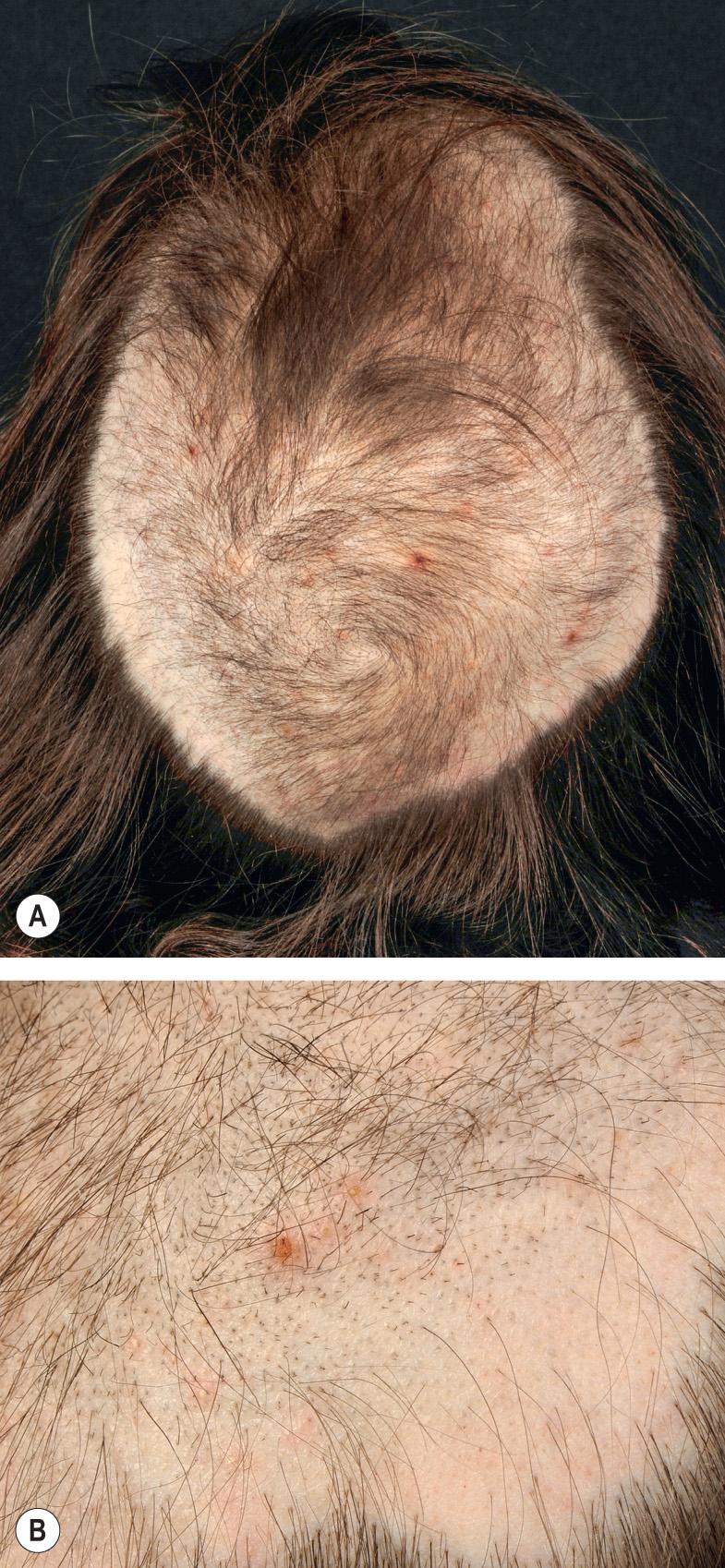 Fig. 69.15, Trichotillomania.