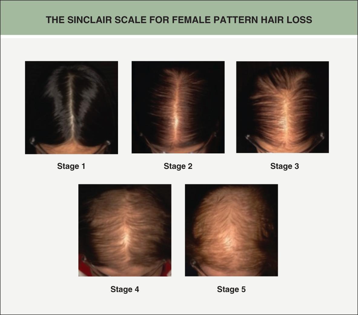 Fig. 69.5, The Sinclair scale for female pattern hair loss.