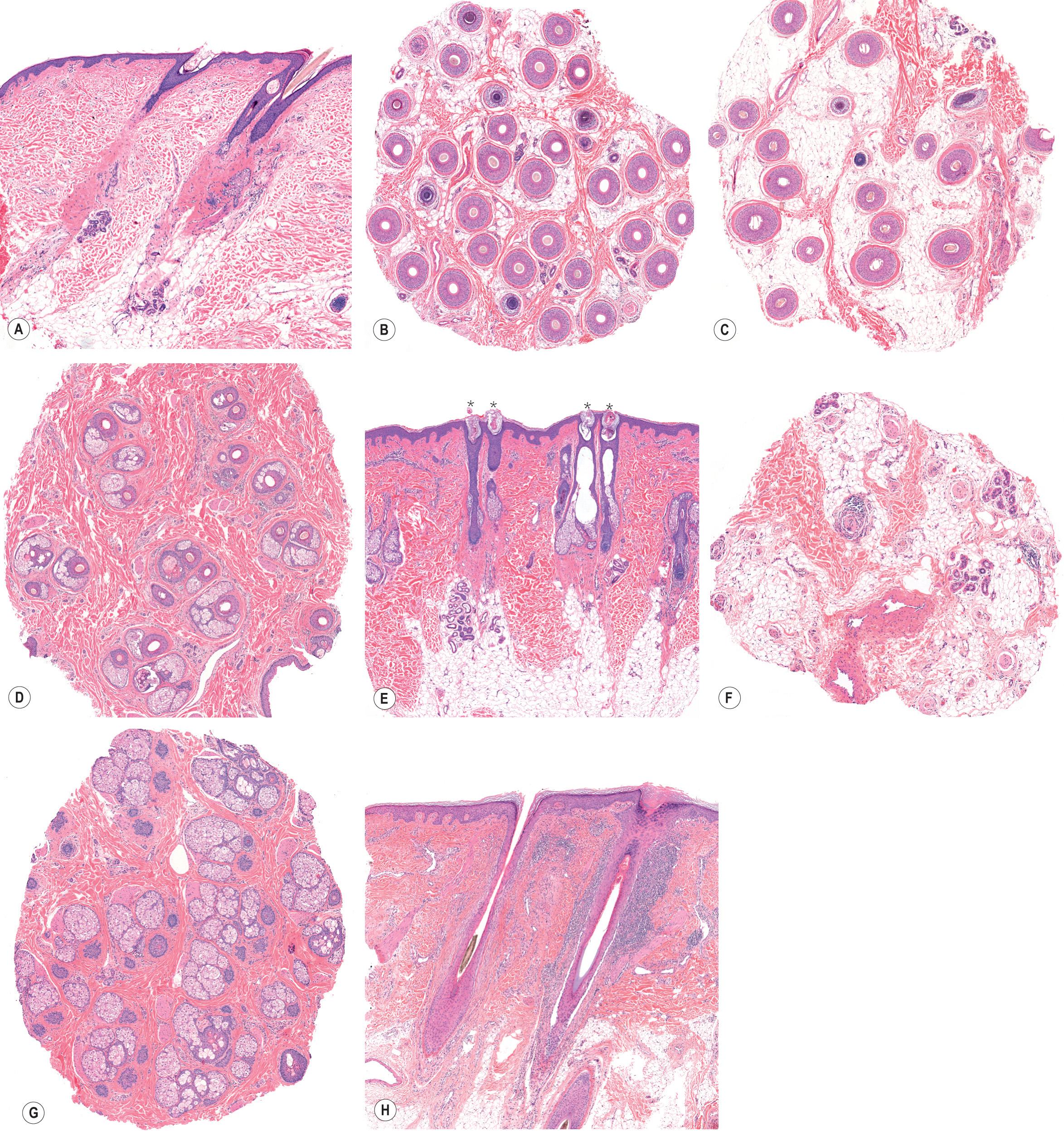 Fig. 69.9, Histologic features of androgenetic alopecia, alopecia areata, and lichen planopilaris.