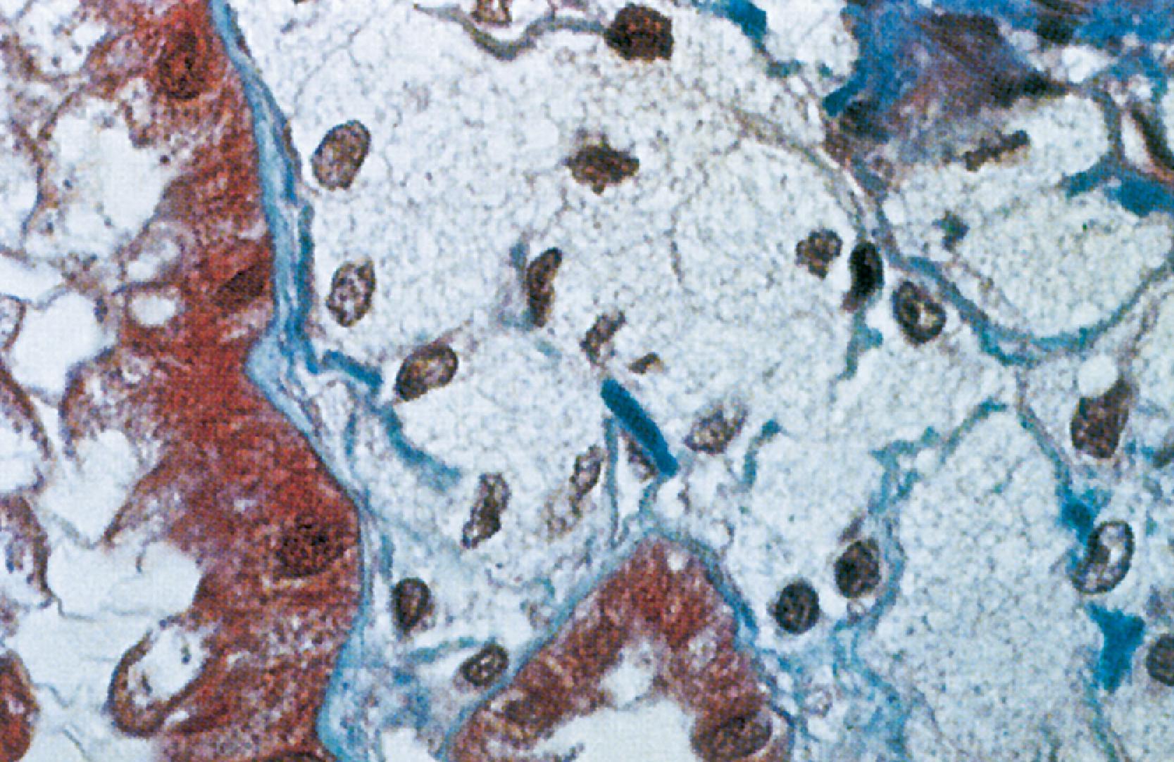 Fig. 41.1, High-power photomicrograph shows foam-filled tubular and interstitial cells in a kidney biopsy specimen from a patient with Alport syndrome. Relatively normal proximal tubular cytoplasm stains red in the tubules on the left and at the bottom. The remaining cells appear “foamy” because of the spaces left where lipids have been eluted during processing.