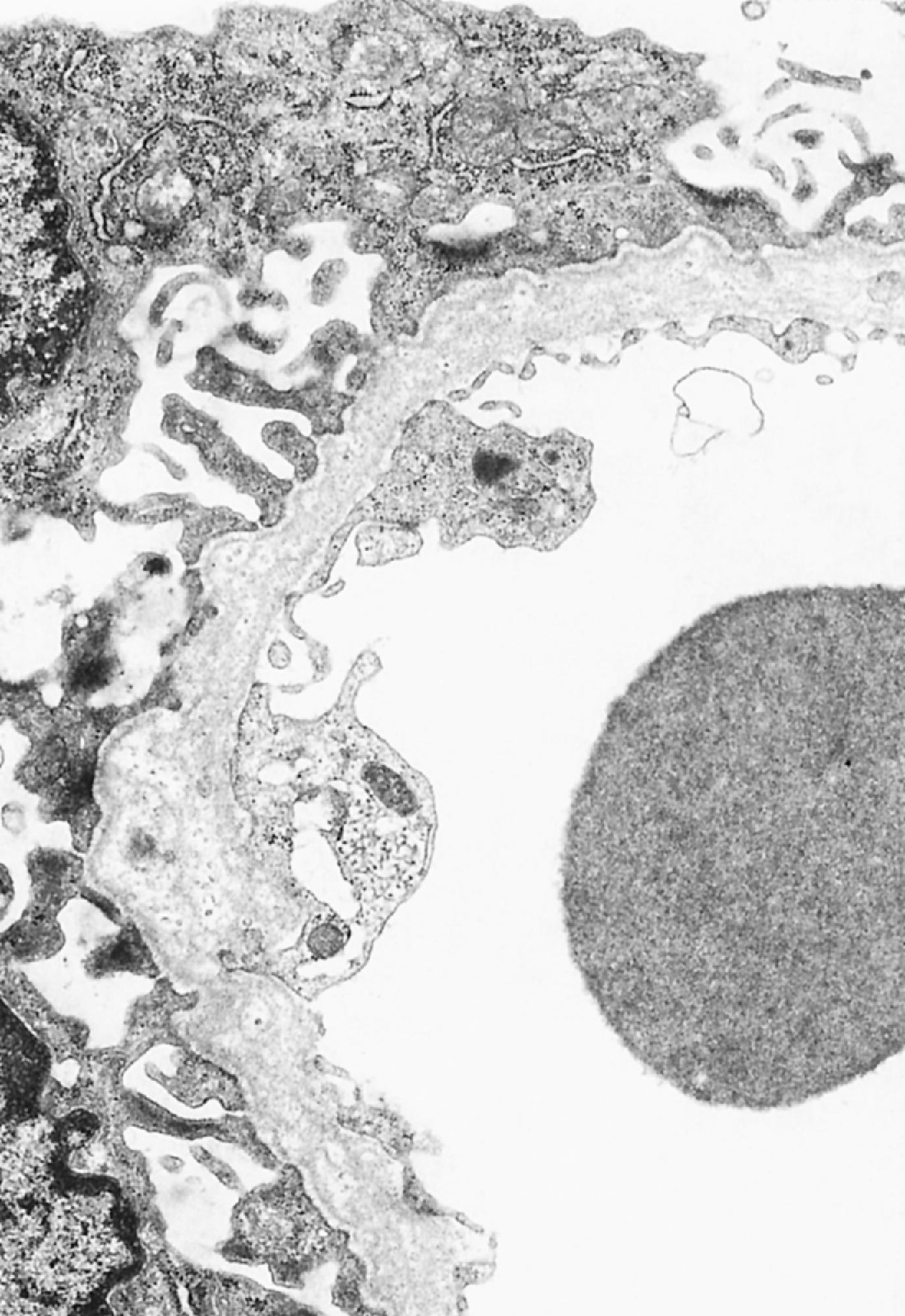 Fig. 41.2, High-resolution electron micrograph shows a glomerular basement membrane from a patient with Alport syndrome that varies in thickness. It is split into several layers, which in some areas are separated by lucencies containing small, dense granules. (Courtesy Dr. Theodore J. Pysher.)