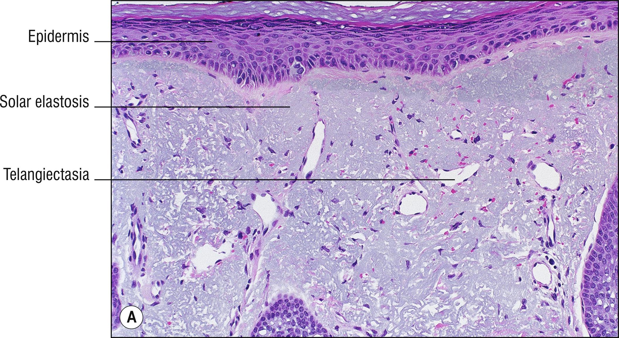 Fig. 9.1, A Solar elastosis with telangiectasia.