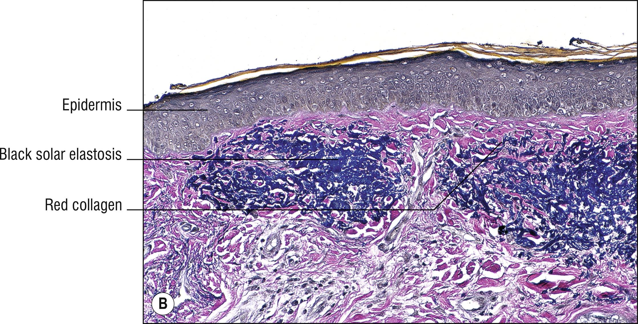 Fig. 9.1, B Solar elastosis (VVG stain).