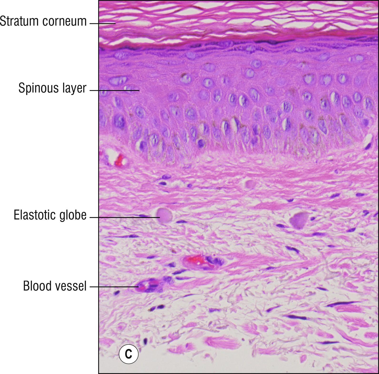 Fig 9.1, C Elastotic globes.