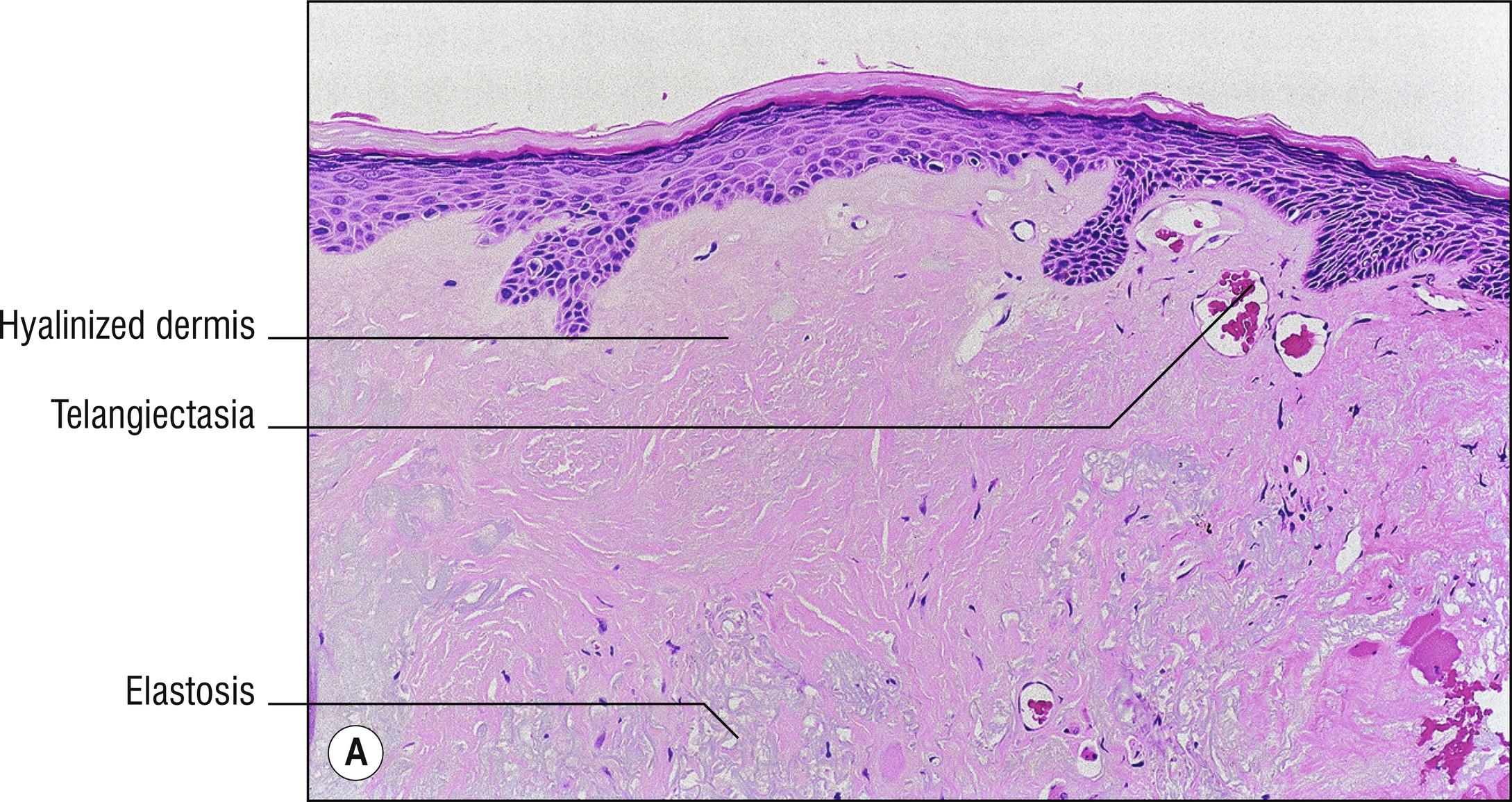 Fig. 9.2, A Radiodermatitis (low mag.).