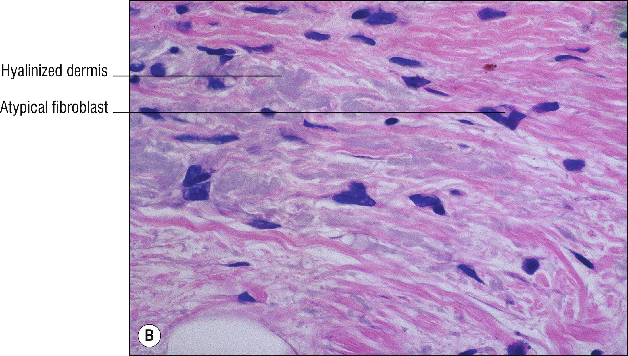 Fig. 9.2, B Radiodermatitis (high mag.).