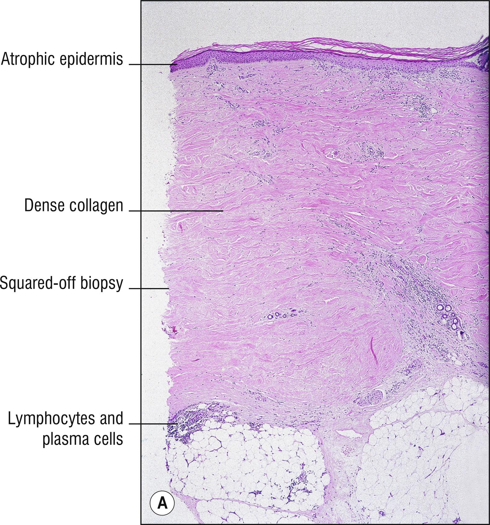 Fig. 9.3, A Morphea (low mag.).