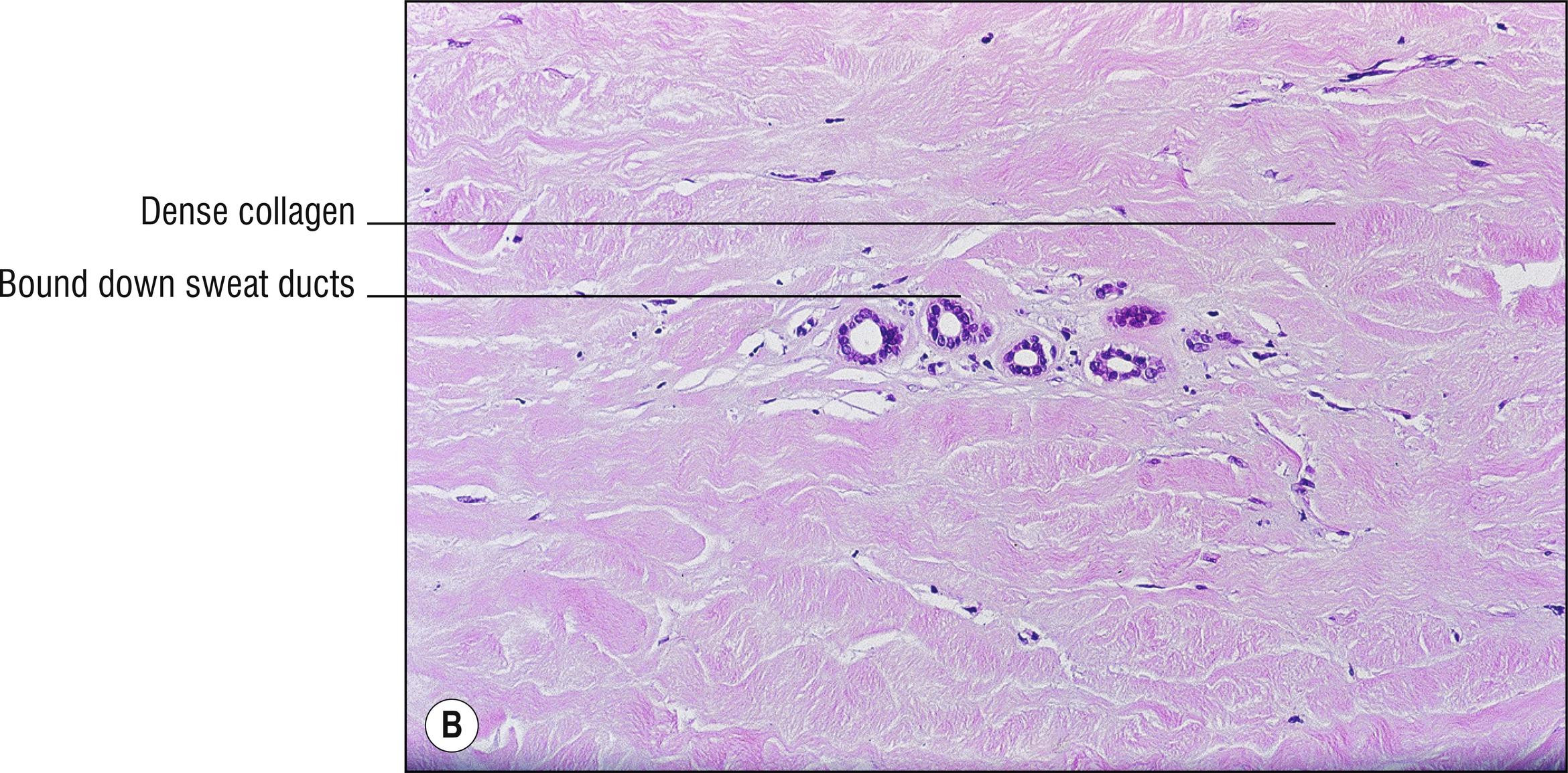 Fig. 9.3, B Morphea (high mag.).