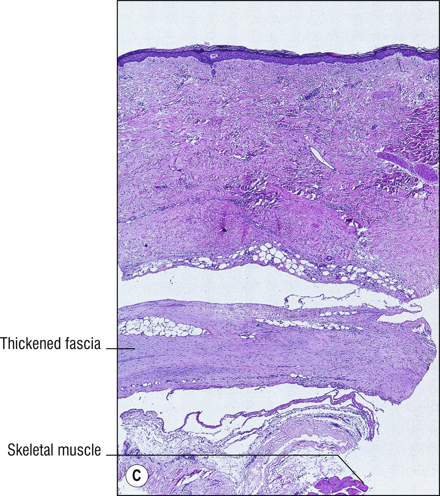 Fig. 9.3, C Eosinophilic fasciitis (low mag.).