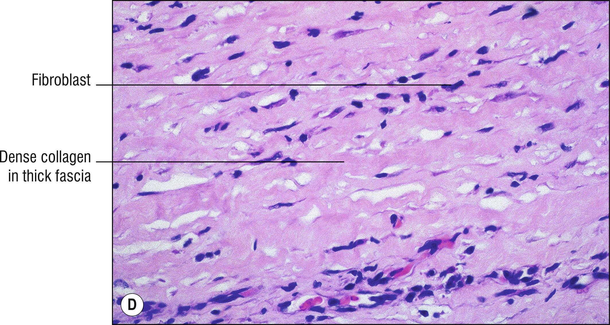 Fig. 9.3, D Eosinophilic fasciitis (high mag.).