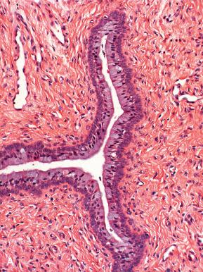 Fig. 18.1, Origins of squamous epithelium in the lower genital tract. A, In the newborn mouse, reserve cells are induced at the epithelial–stromal interface in the vagina, resulting in a bilayered epithelium at birth. B, Following estrogenic stimulation, these cells undergo squamous differentiation with shedding of the overlying columnar epithelium. In people, the process of squamous differentiation occurs prior to birth.