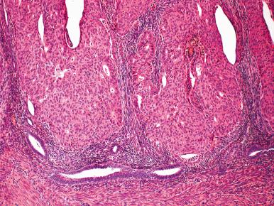 Fig. 18.11, Sheets of cohesive morular metaplasia with focal glandular differentiation.