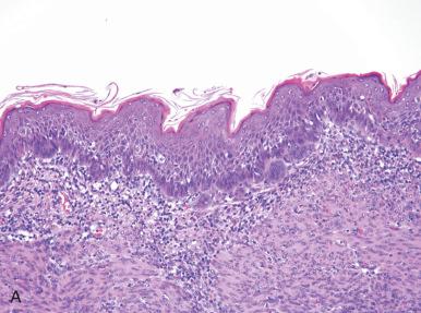 Fig. 18.12, A, Benign-appearing squamous differentiation on the endometrial surface. B, Squamous carcinoma of the endometrium from the same case.