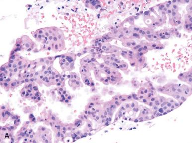 Fig. 18.14, A, B, Mucinous differentiation with complex (papillary and microacinar) architecture (type C). The proliferation in image B ismore subtle; however, both were associated with coexisting grade I endometrioid adenocarcinoma.