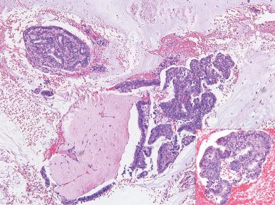 Fig. 18.18, Microglandular changes (upper left) associated with subtle carcinoma (center right). Another cluster of neoplastic endometrial epithelium is seen in this case (inset) .