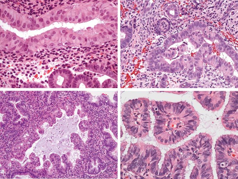 Fig. 18.20, Tubal metaplasia in glands. A, Simple. B, Mildly complex. C, Endometrial intraepithelial neoplasia (EIN), with intraglandular complexity. D, EIN, with papillary architecture.