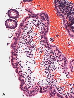 Fig. 18.21, Tubal metaplasia on the surface. A, Simple. B, C, Complex, with microacinar changes. The underlying glands are also atypical in C. B and C are associated with endometrial carcinoma.