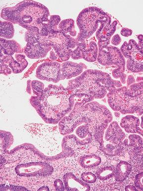 Fig. 18.22, A, Endometrial adenocarcinoma with tubal differentiation (ciliated adenocarcinoma). B, Higher power illustrates the prominent cilia.