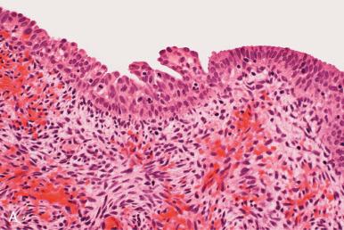 Fig. 18.4, Possible origins of basal or reserve cells in the uterus in a postmenopausal woman. A, Reserve cells underlie a micropapillary proliferation of surface epithelium (center). B, Otherwise inconspicuous basal cells in this postmenopausal uterus are highlighted by p63 staining (C). D, Squamous metaplasia (upper) is admixed with and distinguished from columnar epithelium by the presence of p63-positive cells (E). F, Squamous metaplasia is often present on the luminal surface in the glandular epithelium (center) .