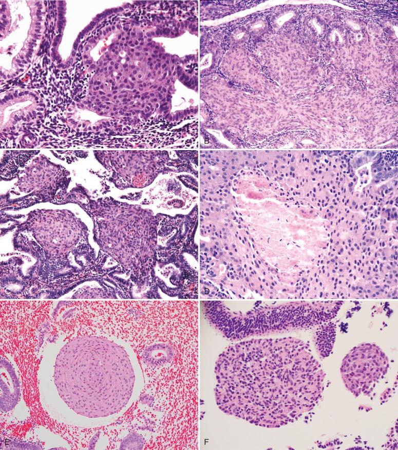 Fig. 18.7, A, Isolated squamous morules, with no coexisting glandular proliferation. This carries a low risk of subsequent adenocarcinoma. B, Squamous morules associated with scattered noncrowded glands at the periphery. C, Morular metaplasia, with gland crowding and minimal atypia. D, Central necrosis is common in morules (center). E, Detached morule unassociated with glandular epithelium. F, Detached morules should be distinguished from aggregates of histiocytes.