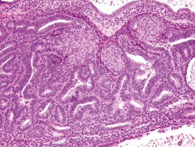 Fig. 18.8, Squamous morules with a discrete population of crowded glands justifying a diagnosis of endometrial intraepithelial neoplasia. Note the atrophic gland at the far right for comparison.