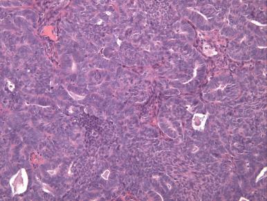 Fig. 18.9, Endometrial adenocarcinoma with discrete nests of squamous differentiation (top left) .