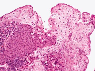 Fig. 18.10, Disorganized squamous differentiation associated with endometrial adenocarcinoma.