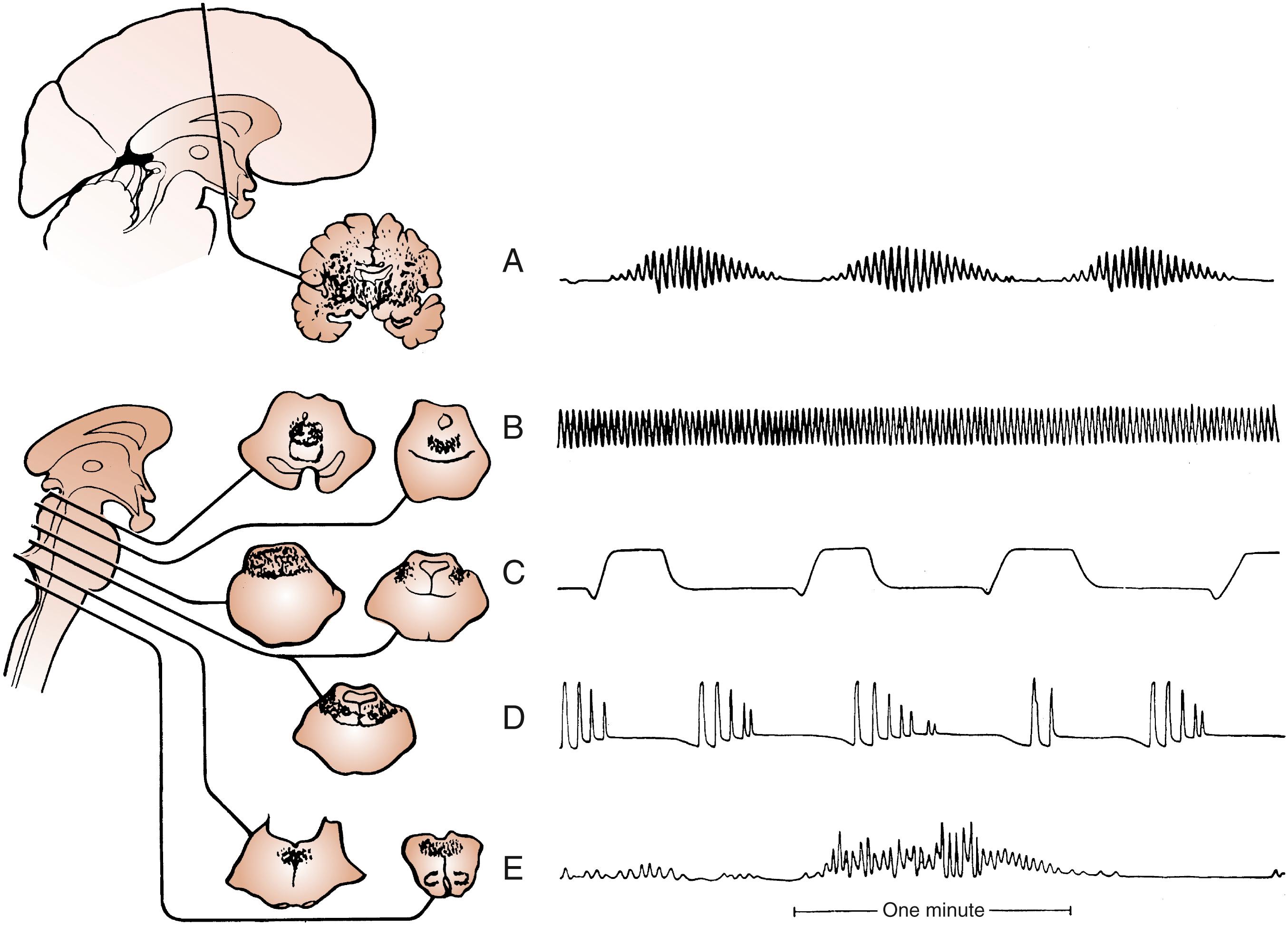 Fig. 41.2, Abnormal respiratory patterns. A, Cheyne-Stokes respiration. B, Central neurogenic hyperventilation. C, Apneusis. D, Cluster breathing. E, Ataxic breathing. Shaded areas show location of brain pathology associated with abnormal respiratory pattern.