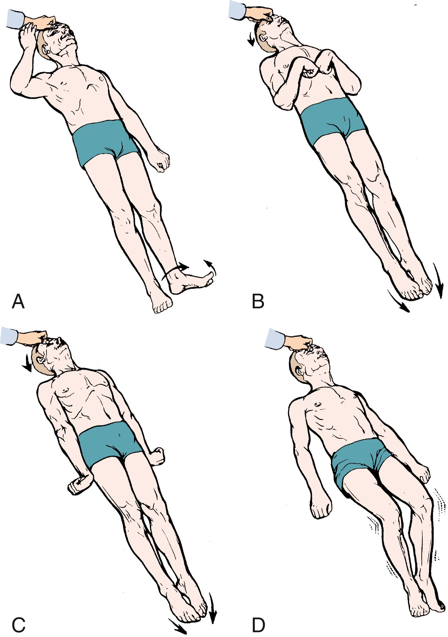 Fig. 41.3, Motor response to noxious stimuli. A, Localization. B, Decorticate posturing. C, Decerebrate posturing. D, Opisthotonos posturing.