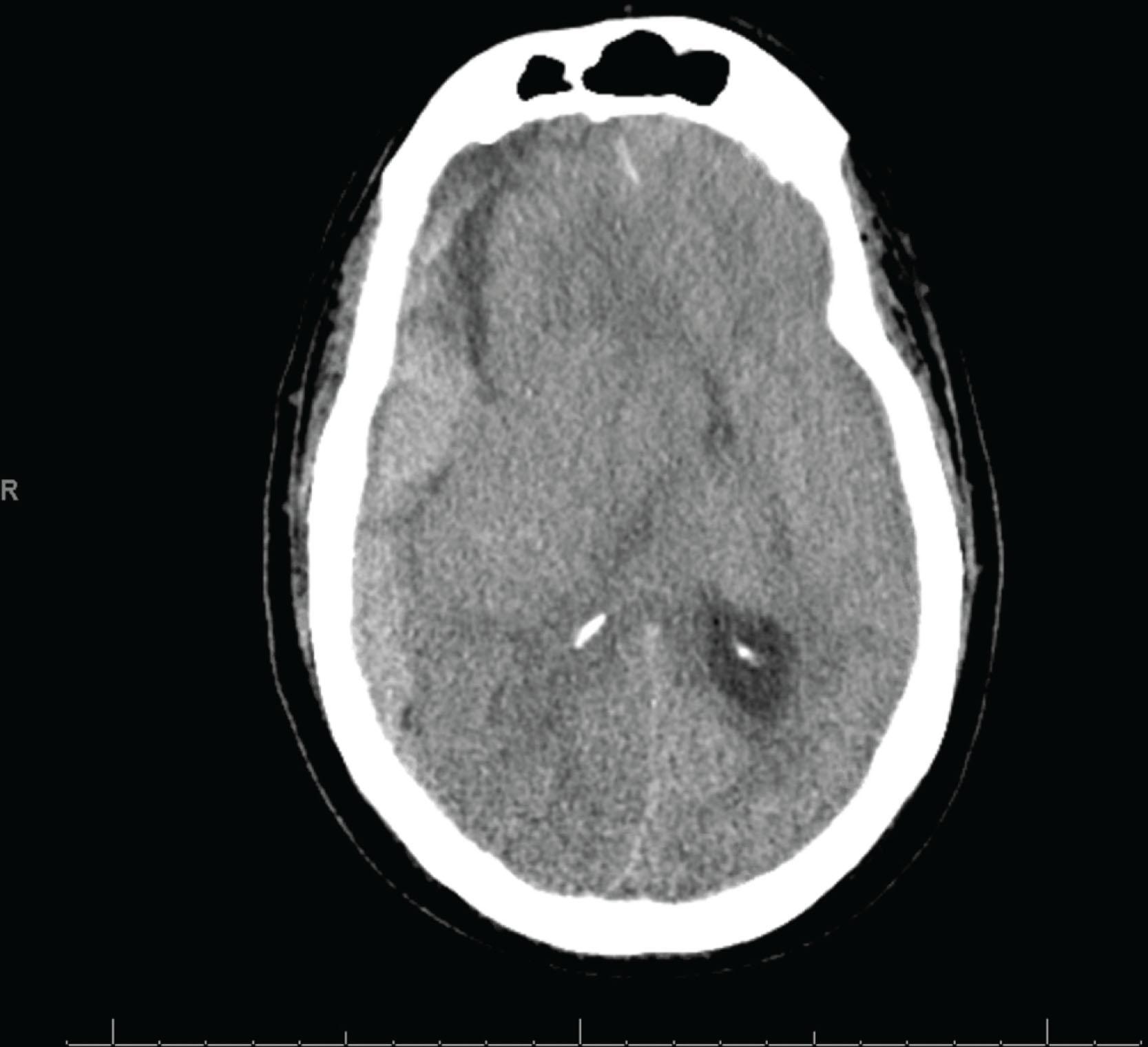 Fig. 36.1, Computed tomography of the axial head section showing right-sided subdural hemorrhage, midline shift, and right lateral ventricle effacement.